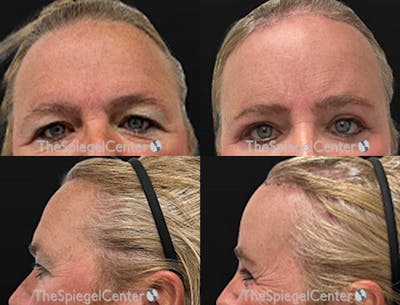 Forehead Contouring Before & After Gallery - Patient 349231 - Image 1