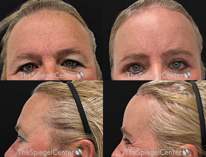 Forehead Contouring Before & After Gallery - Patient 349231 - Image 1
