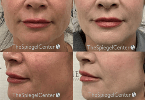 Lip Lift Before & After Gallery - Patient 340080 - Image 1