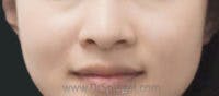 Mole Removal Before & After Gallery - Patient 420754 - Image 2