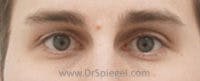 Mole Removal Before & After Gallery - Patient 178358 - Image 1