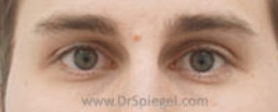 Mole Removal Before & After Gallery - Patient 178358 - Image 1