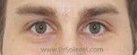 Mole Removal Before & After Gallery - Patient 178358 - Image 2