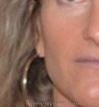 Mole Removal Before & After Gallery - Patient 204639 - Image 2