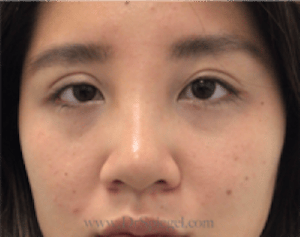 Blepharoplasty
