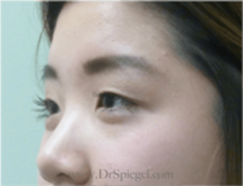 Monolid/Double Eyelid Surgery Before & After Gallery - Patient 813326 - Image 3