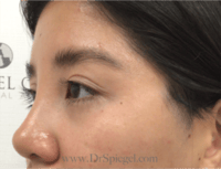 Blepharoplasty Before & After Gallery - Patient 143545 - Image 4