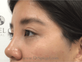 Blepharoplasty Before & After Gallery - Patient 143545 - Image 4