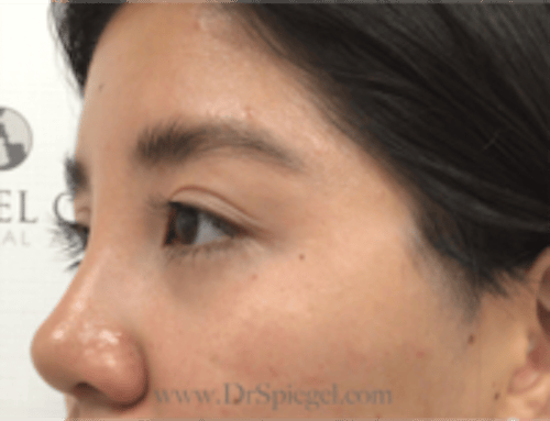 Monolid/Double Eyelid Surgery Before & After Gallery - Patient 813326 - Image 4