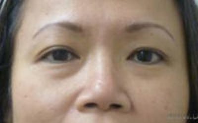 Monolid / Double Eyelid Surgery Before & After Gallery - Patient 405485 - Image 1