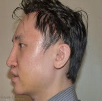 FFS Scalp Advancement Before & After Gallery - Patient 101806 - Image 2