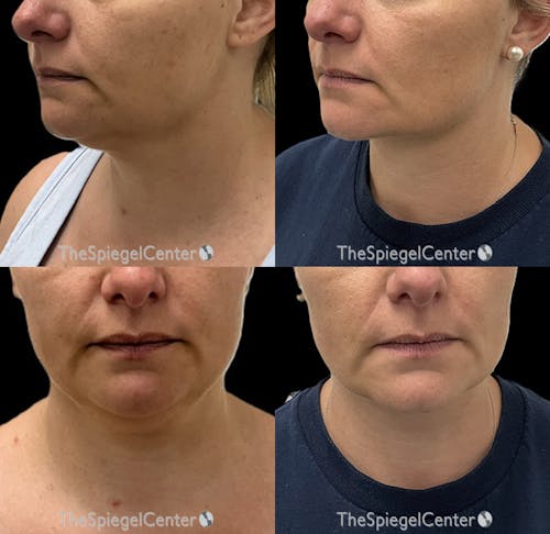 Neck Lift Before & After Gallery - Patient 421585 - Image 1