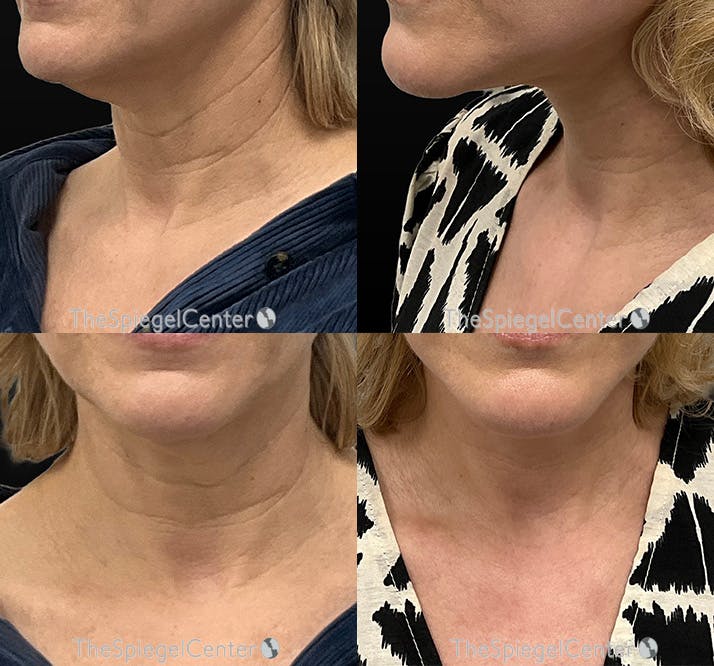 Neck Lift Before & After Gallery - Patient 418581 - Image 1
