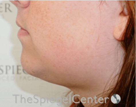 Neck Lipo Before & After Gallery - Patient 218155 - Image 3