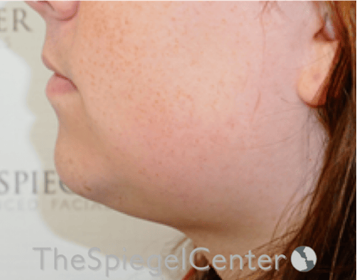 Neck Lipo Before & After Gallery - Patient 218155 - Image 3