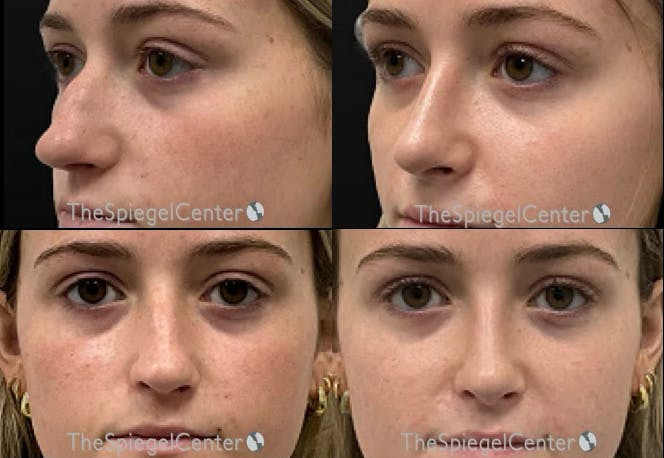 Rhinoplasty Before & After Gallery - Patient 319245 - Image 1