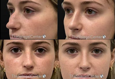 Rhinoplasty Before & After Gallery - Patient 319245 - Image 1