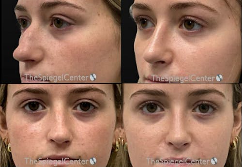 Rhinoplasty Before & After Gallery - Patient 319245 - Image 1