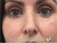 Rhinoplasty Before & After Gallery - Patient 997033 - Image 4