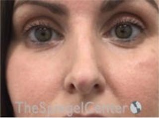 Rhinoplasty Before & After Gallery - Patient 997033 - Image 4