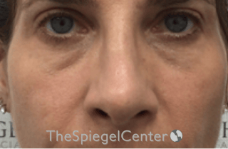 Rhinoplasty Before & After Gallery - Patient 785559 - Image 4