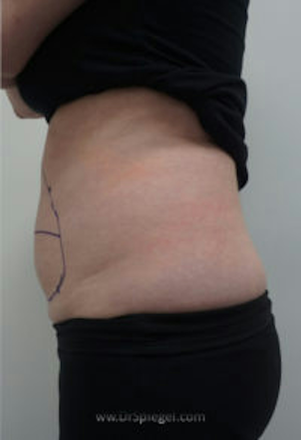 BodyTite