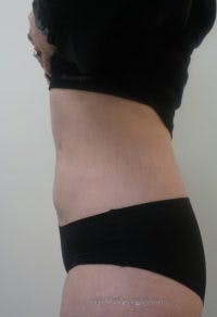 Bodytite Before & After Gallery - Patient 304759 - Image 4