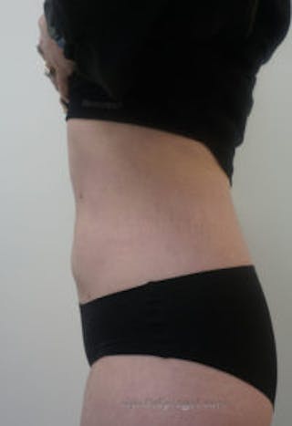 Bodytite Before & After Gallery - Patient 304759 - Image 4