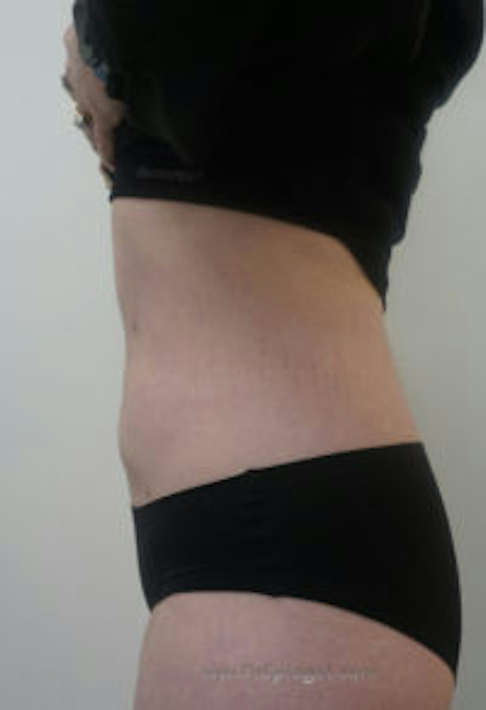 BodyTite
