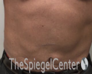 Bodytite Before & After Gallery - Patient 764209 - Image 2