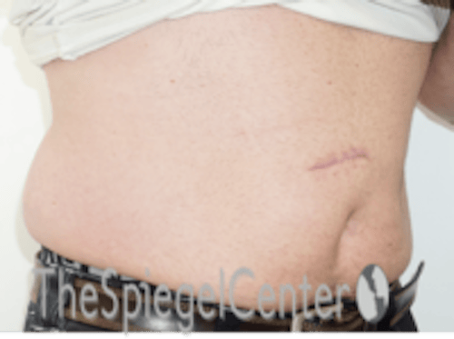 Bodytite Before & After Gallery - Patient 764209 - Image 3