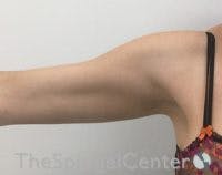 Bodytite Before & After Gallery - Patient 146240 - Image 1