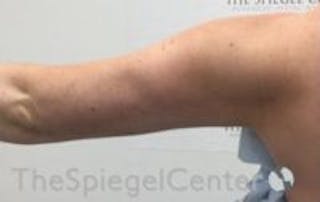 Bodytite Before & After Gallery - Patient 146240 - Image 4