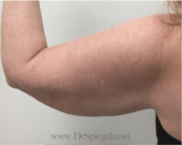 Bodytite Before & After Gallery - Patient 345772 - Image 3