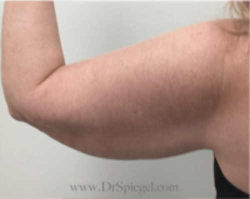 Bodytite Before & After Gallery - Patient 345772 - Image 3