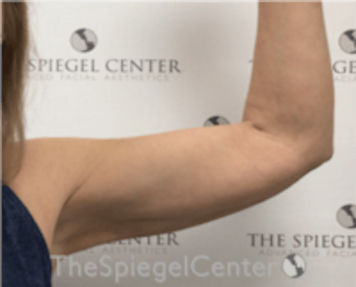 Bodytite Before & After Gallery - Patient 229771 - Image 2