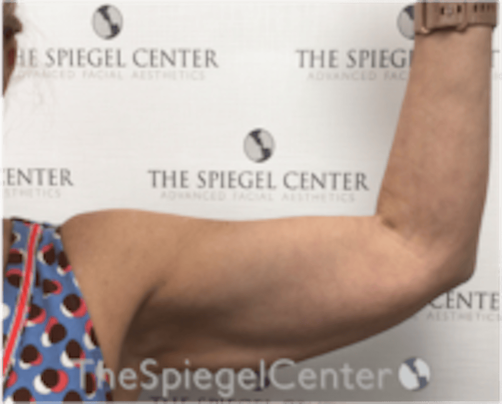 Arm Lift with BodyTite