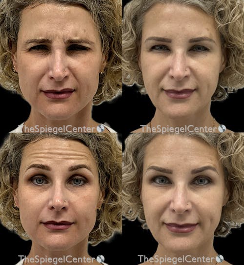 Botox / Dysport / Jeuveau / Xeomin Before & After Gallery - Patient 225984 - Image 1