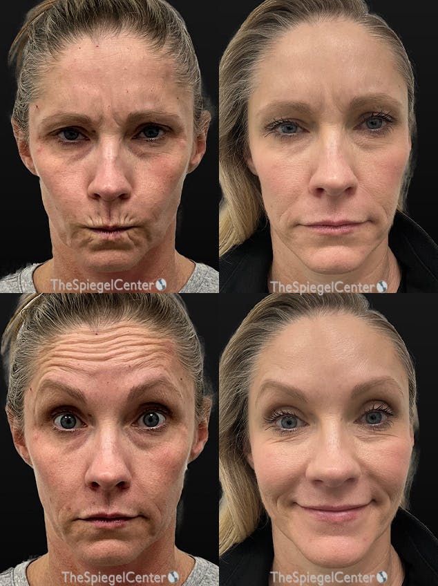 Botox / Dysport / Jeuveau / Xeomin Before & After Gallery - Patient 288437 - Image 1