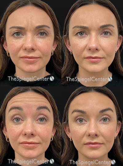 Botox / Dysport / Jeuveau / Xeomin Before & After Gallery - Patient 105154 - Image 1