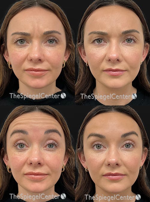 Botox / Dysport / Jeuveau / Xeomin Before & After Gallery - Patient 105154 - Image 1