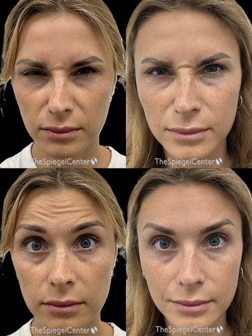 Botox / Dysport / Jeuveau / Xeomin Before & After Gallery - Patient 329810 - Image 1