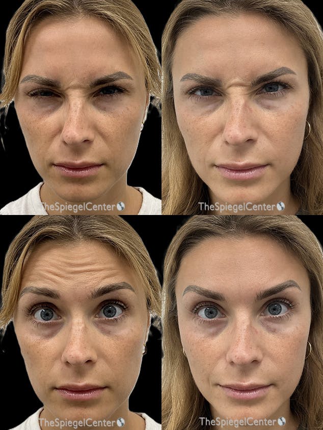 Botox / Dysport / Jeuveau / Xeomin Before & After Gallery - Patient 329810 - Image 1