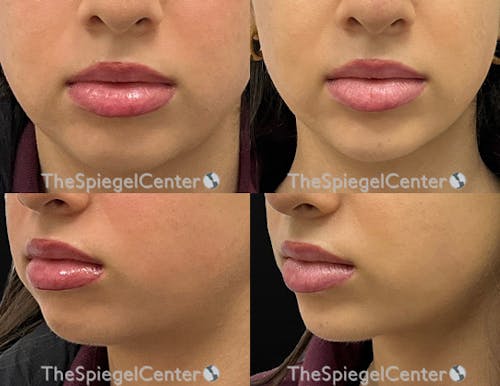 Chin Filler Before & After Gallery - Patient 413289 - Image 1
