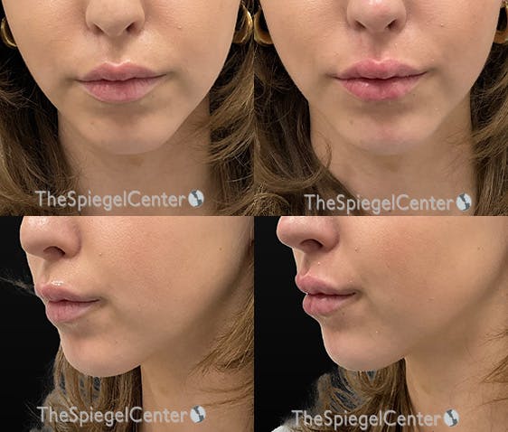 Chin Filler Before & After Gallery - Patient 253237 - Image 1