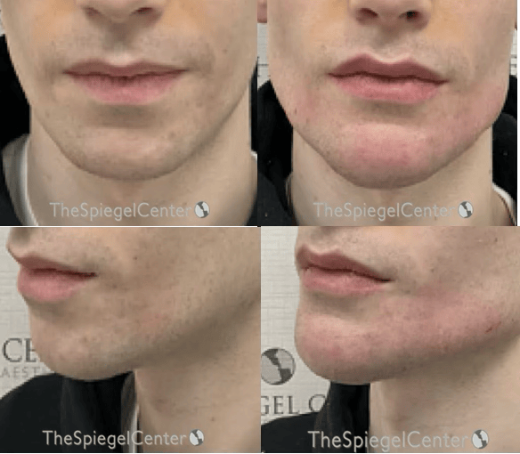 Chin Filler Before & After Gallery - Patient 827522 - Image 1