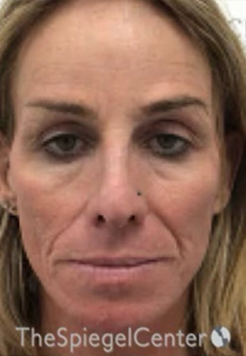 CO2 Laser Before & After Gallery - Patient 415328 - Image 1