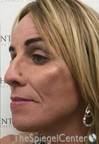 CO2 Laser Before & After Gallery - Patient 415328 - Image 4