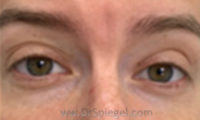 Deep 11 Before & After Gallery - Patient 127961 - Image 1