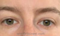 Deep 11 Before & After Gallery - Patient 127961 - Image 2